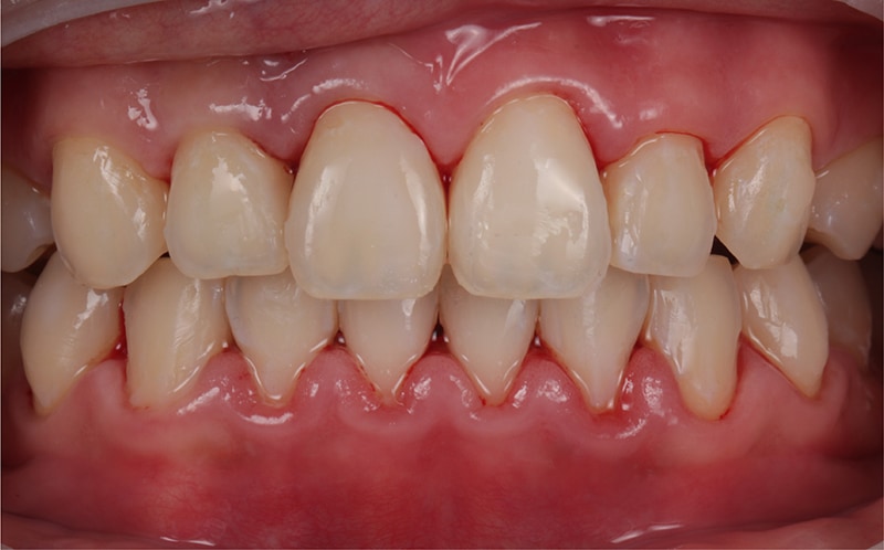 拆除失敗的齒雕美白-牙齦浮腫嚴重