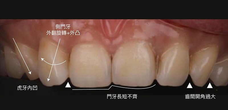 陶瓷貼片-案例-牙齒不整齊-側門牙外突-虎牙內凹-門牙長度不一-齒間開角過大