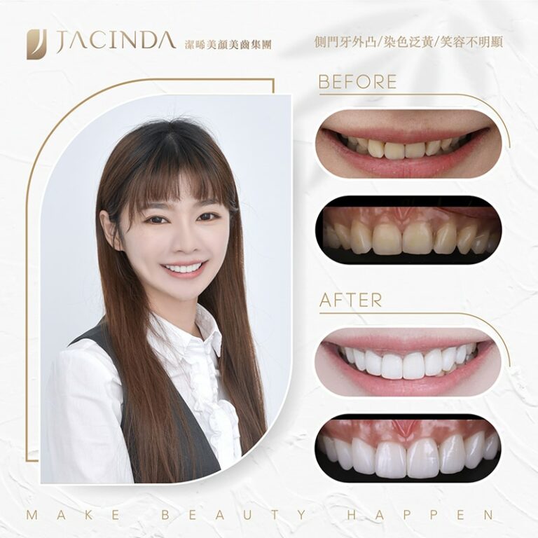 陶瓷貼片-案例-牙齒不整齊-牙齒歪斜-牙齒黃-微笑設計-治療前後比較-台中-美顏美齒-潔晞-JCSmile