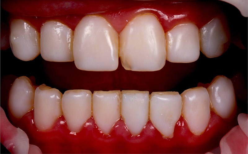 齒雕美白失敗-牙齦發炎-齒雕變色-牙縫染色