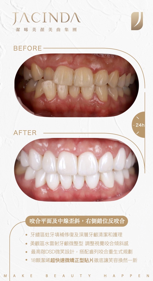 瓷牙貼片-牙縫蛀牙-牙齒錯咬-DSD微笑設計-台中-潔晞美顏美齒