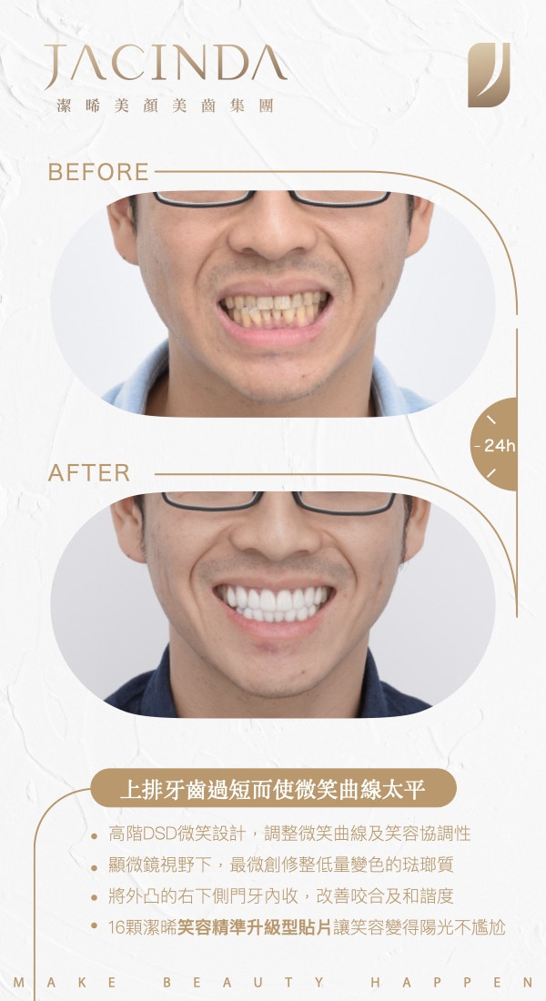 瓷牙貼片-牙齒短-門牙外凸-DSD微笑設計-台中-潔晞美顏美齒