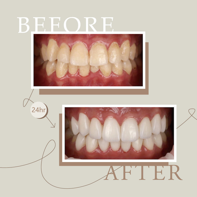 陶瓷貼片-牙齒矯正-牙齒黃-牙齒不整齊-療程前後比較-台中-美顏美齒-潔晞-JCSmile